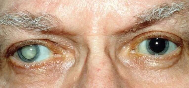Старческая (сенильная) катаракта: причины и лечение