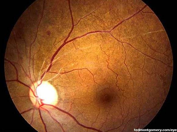 Ангиосклероз сетчатки глаза – что это такое: симптомы и лечение