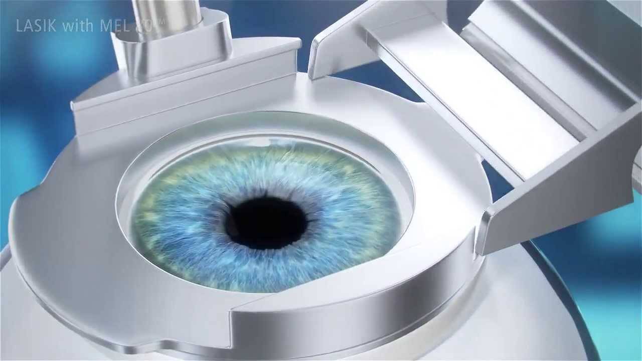 Осложнения и риски лазерной коррекции зрения смайл