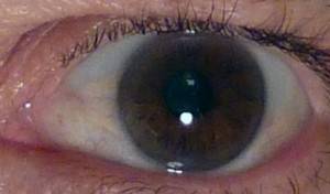 Пингвекула глаза - причины и лечение у взрослых, капли, причины возникновения и методы лечения пингвекулы глаза | медицинский портал spacehealth