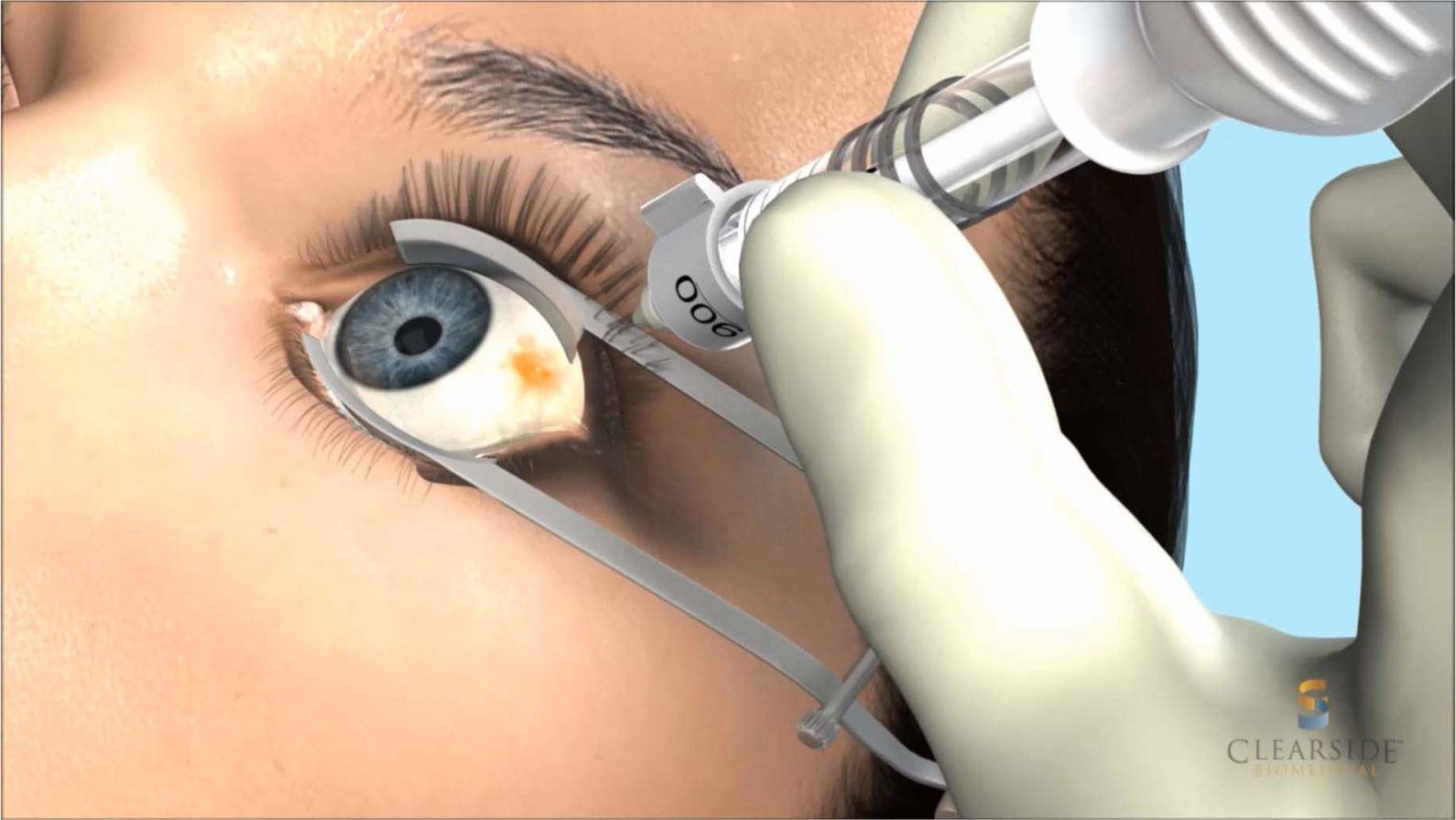 При каких заболеваниях отмечается глубокая инъекция (покраснение) глазного яблока? как она еще называется?