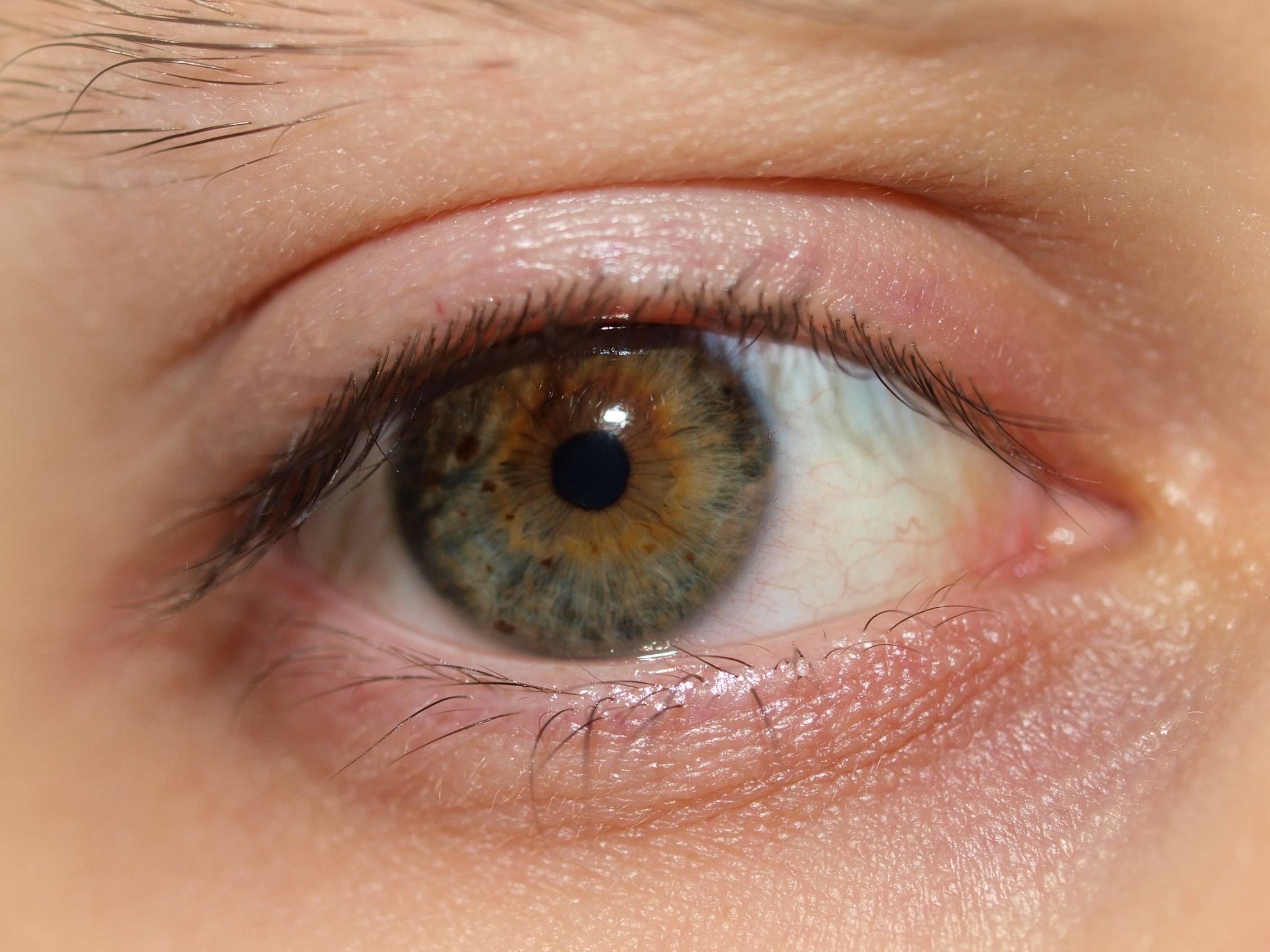 Как лечить синдром сухого глаза дома – 8 рецептов