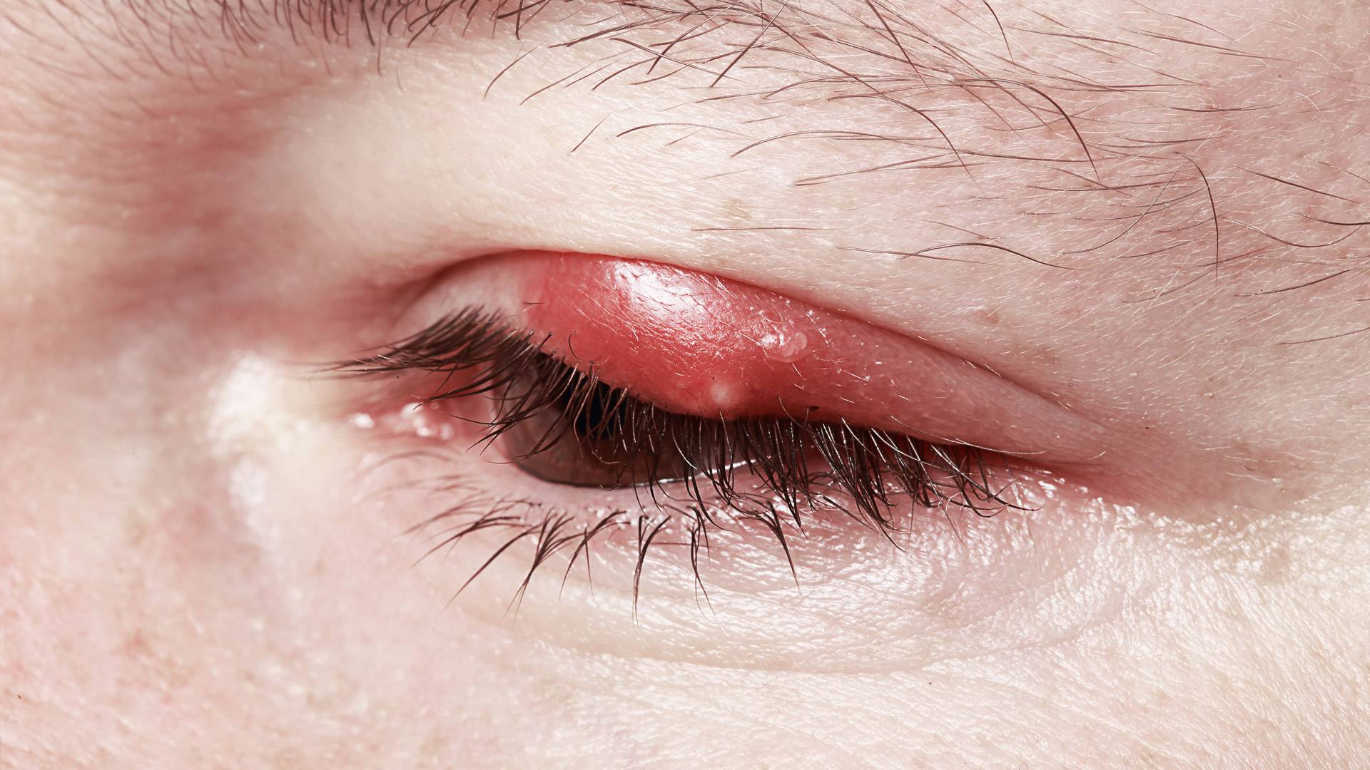 Воспаление глаза: основные причины и лечение oculistic.ru
воспаление глаза: основные причины и лечение