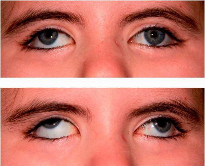 Как избавиться от косоглазия: основные методы лечения и народная медицина — глаза эксперт