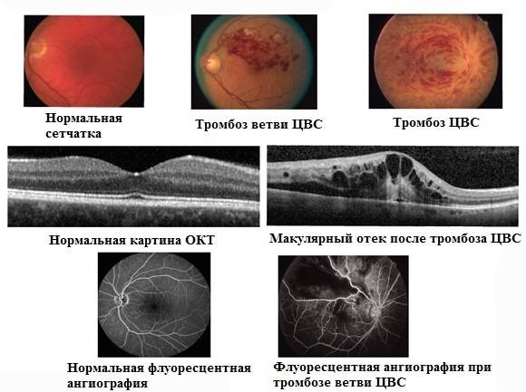 Тромбоз сосудов и центральной вены сетчатки глаза
