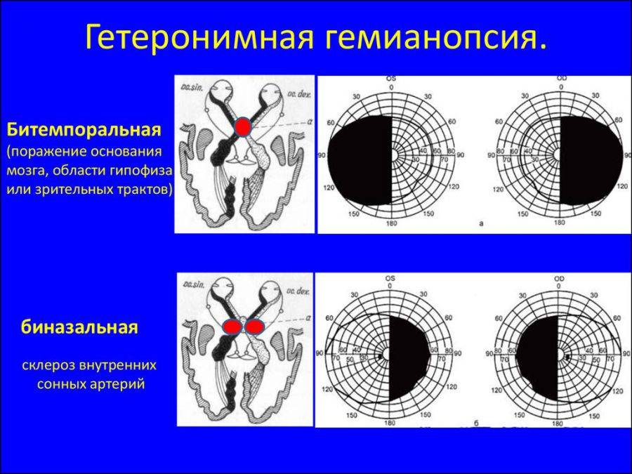 Что такое гемианопсия: виды и методы лечения oculistic.ru
что такое гемианопсия: виды и методы лечения
