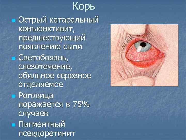 Светобоязнь глаз: причины у взрослого и ребенка, лечение боязни света, симптомы болезней, диагностика, профилактика фотофобии