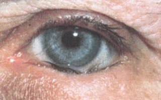 Трихиаз  - симптомы болезни, профилактика и лечение трихиаза, причины заболевания и его диагностика на eurolab