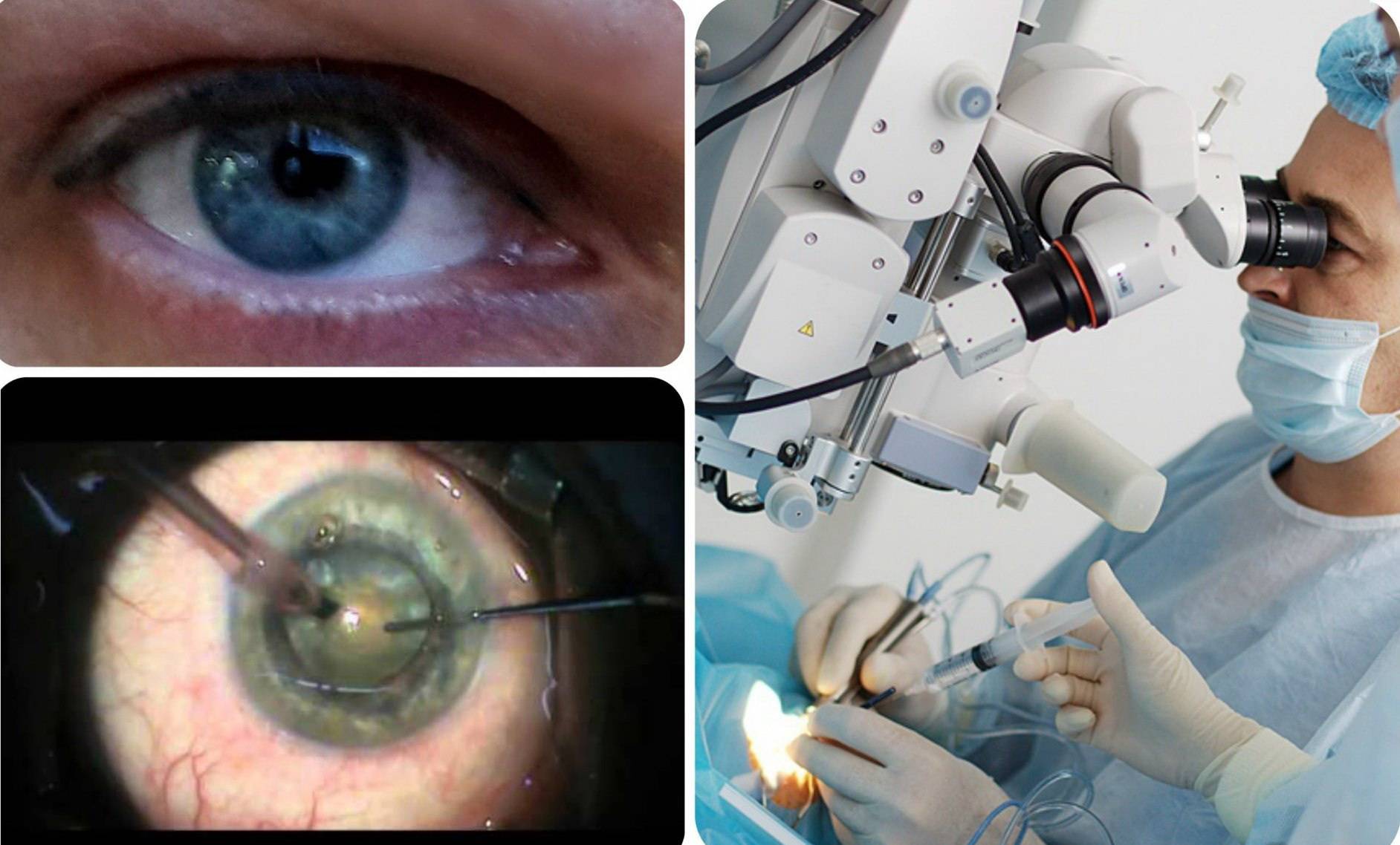 Операция по замене хрусталика глаза: суть, показания, реабилитация