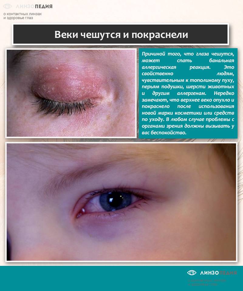 Веко опухло над глазом: причины, симптомы, народные и медикаментозные средства лечения - sammedic.ru