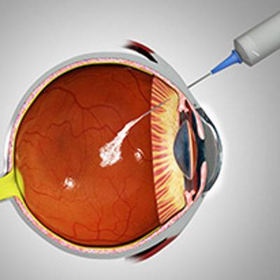 Уколы в глаза: виды и препараты для инъекций в глазное яблоко
