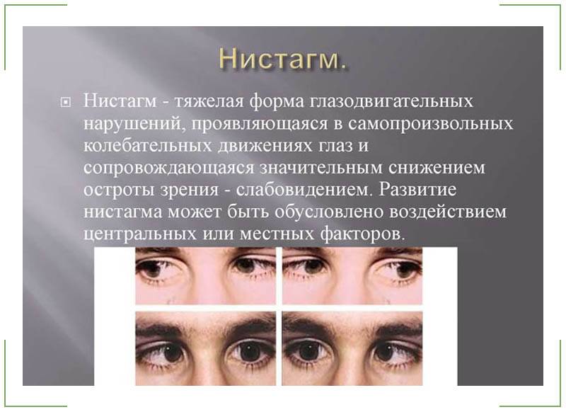 Что такое горизонтальный нистагм и как его лечить oculistic.ru
что такое горизонтальный нистагм и как его лечить