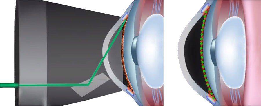 Лазерная базальная иридэктомия при глаукоме - как проходит операция по удалению, послеоперационный период, ограничения, можно ли делать