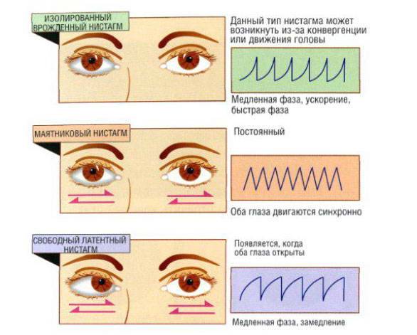 Нистагм: особенности и виды заболевания — глаза эксперт