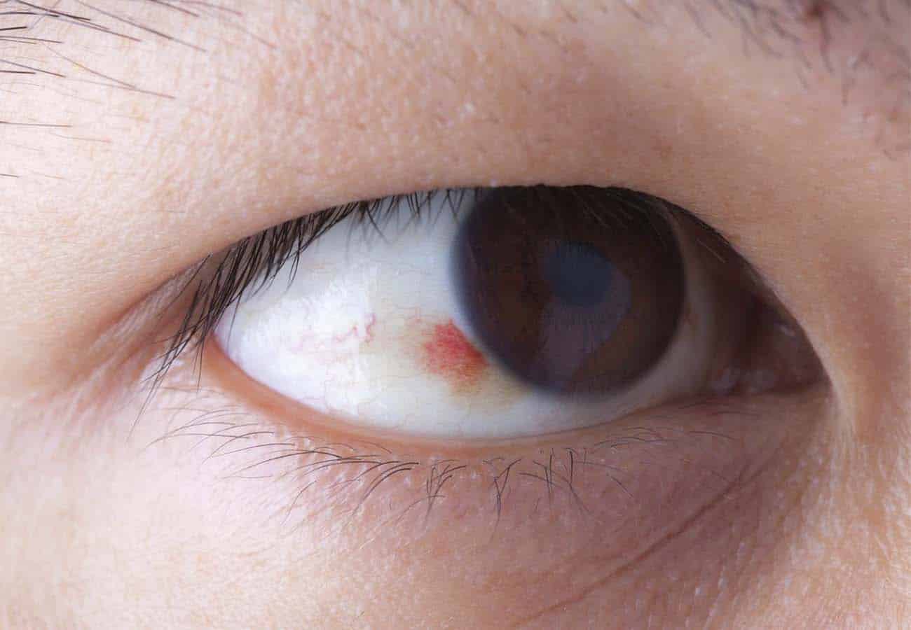 Пятно на белке глаза: причины, лечение, профилактика - "здоровое око"