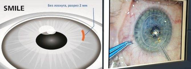 Операция ласик или эксимерлазерная коррекция зрения
