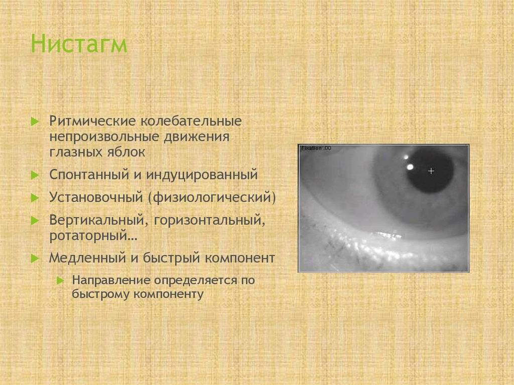 Нистагм глаз: что это такое, симптомы и лечение, причины и виды