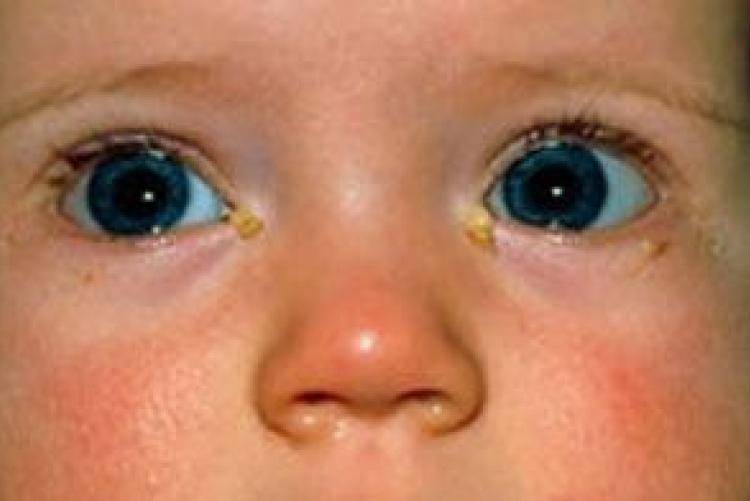 Так нужно ли идти с ребенком к врачу, если у него воспалились глазки?