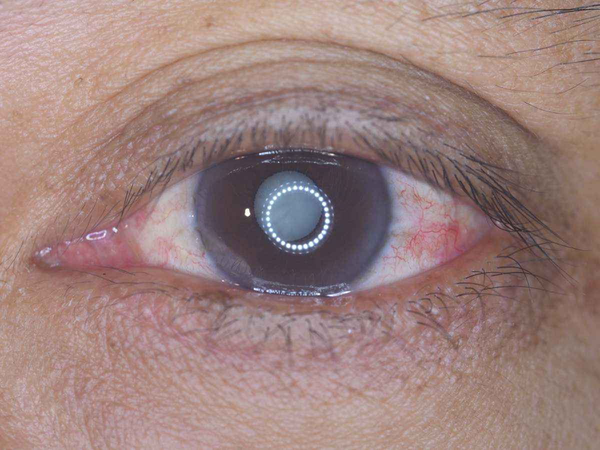 Факосклероз хрусталика глаза: что это такое, диагностика и лечение