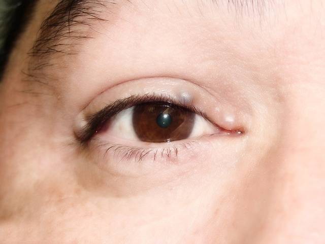 Киста глаза — причины, симптомы и лечение (фото)