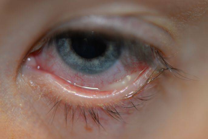 Белый налет в уголках глаз у взрослых: причины и лечение