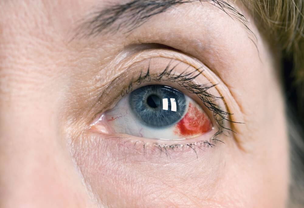 Кровоизлияние в глаз