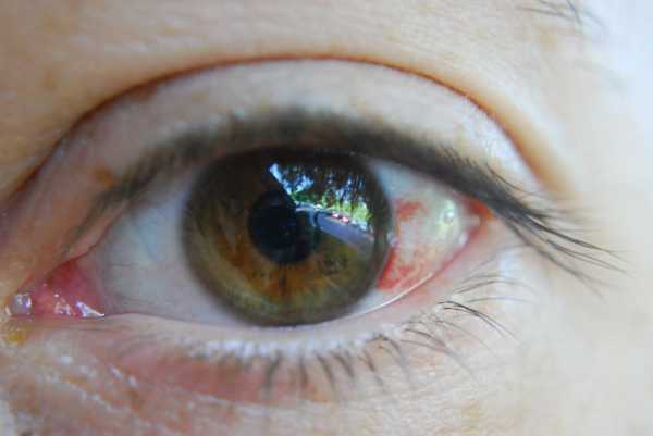 Что делать если в глазу лопнул капилляр?
