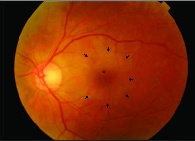 Макулярный отек сетчатки глаза: симптомы, диагностика и лечение. клиники. консультация офтальмолога.