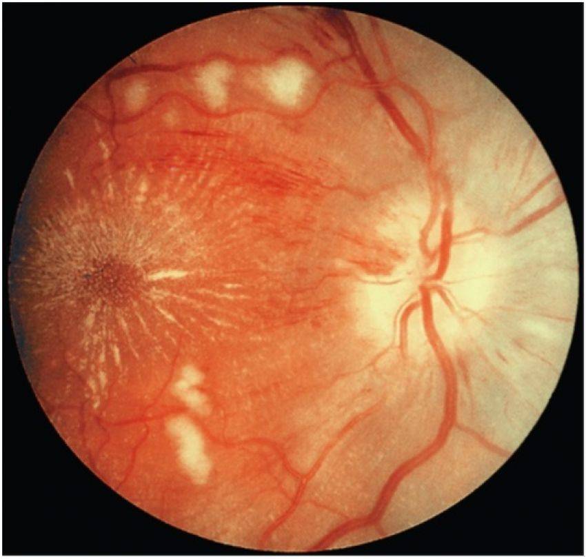 Ангиопатия сосудов сетчатки глаза: причины, диагностика и лечение