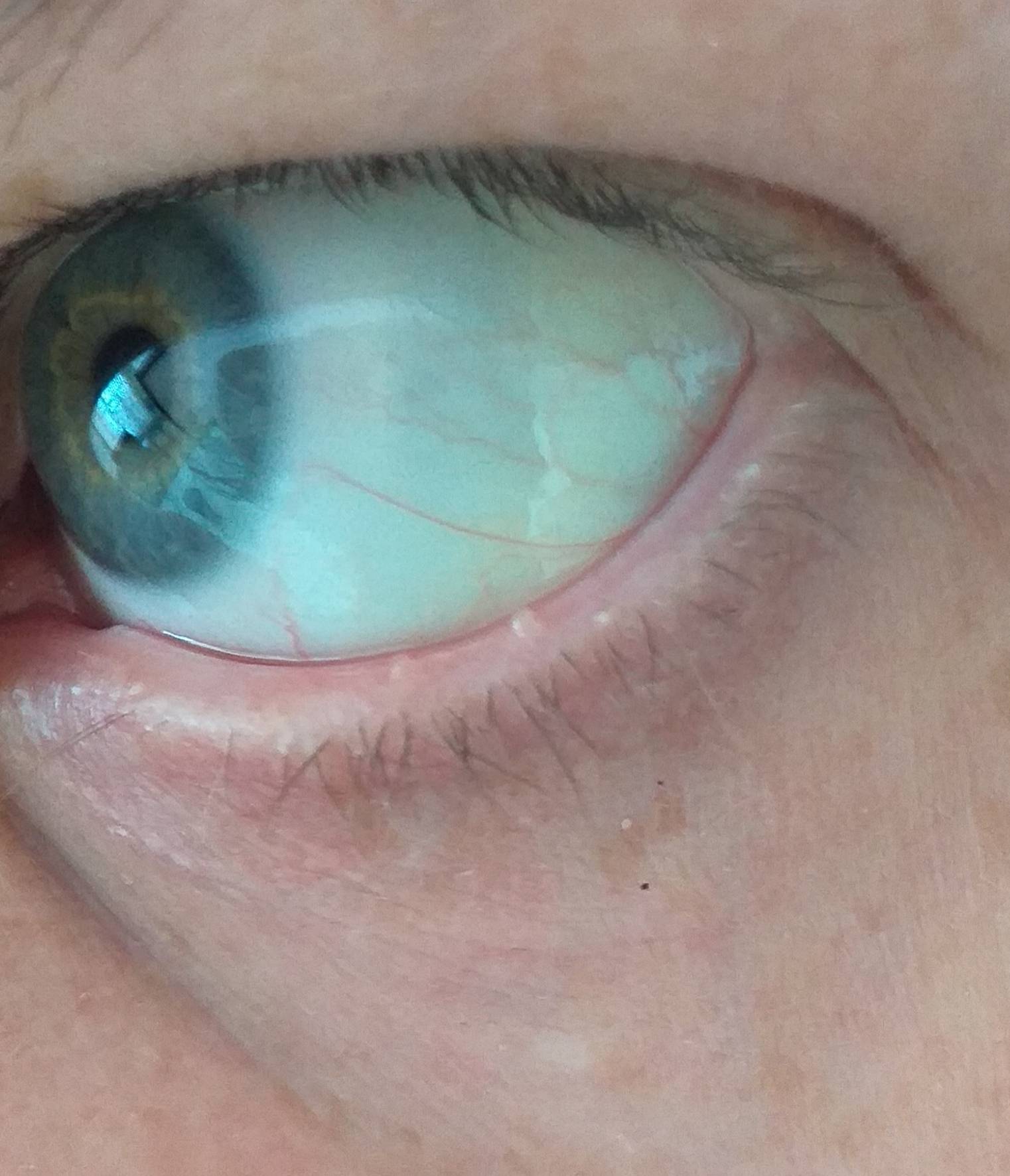 Голубые белки глаз - причины, что это означает