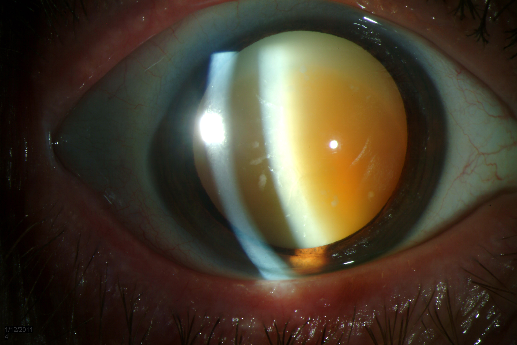 Вторичная катаракта после замены хрусталика: лечение глаза с искусственным хрусталиком, причины и симптомы