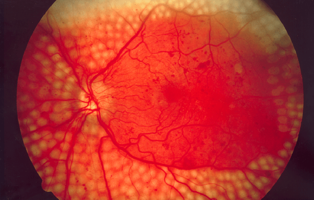Фоновая ретинопатия: симптомы и лечение