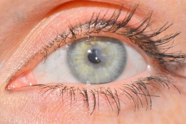Гиперемия конъюнктивы: причины и лечение покраснения белка глаза и воспаления, как снять, чем лечить