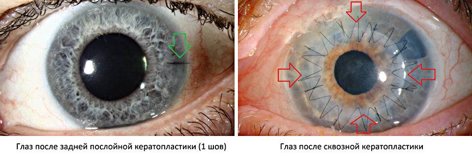 Трансплантация роговицы глаза