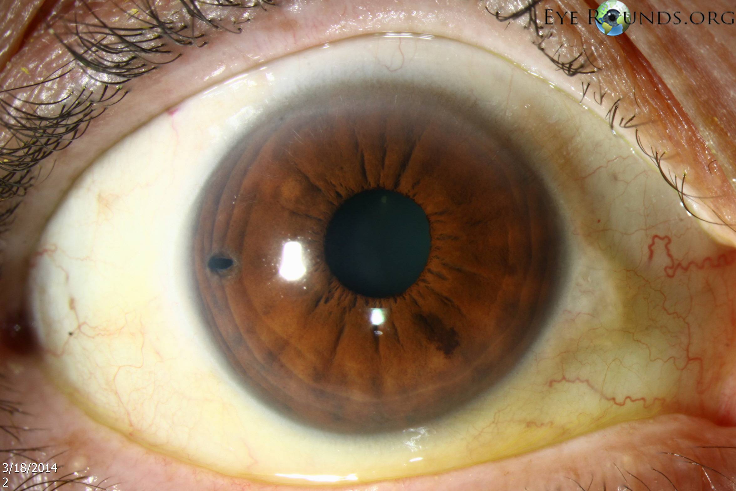 Лазерное лечение глаукомы – плюсы и минусы операции лазером