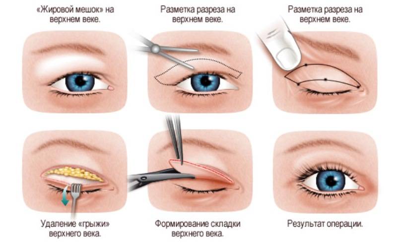 Краткий обзор видов операций на глазах