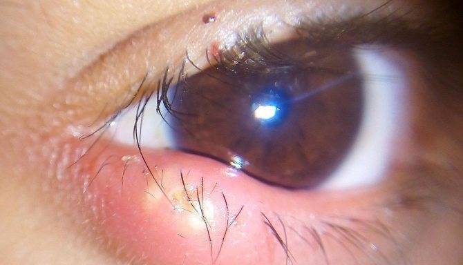 Ячмень на нижнем веке глаза: как и чем быстро вылечить воспаление