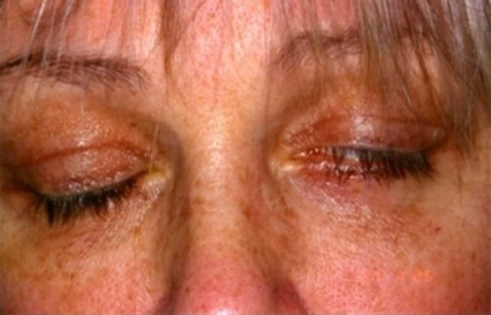 Эндофтальмит глаза: симптомы, лечение, причины, осложнения и профилактика