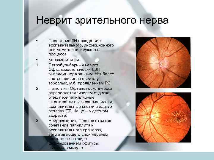 Неврит глазного нерва