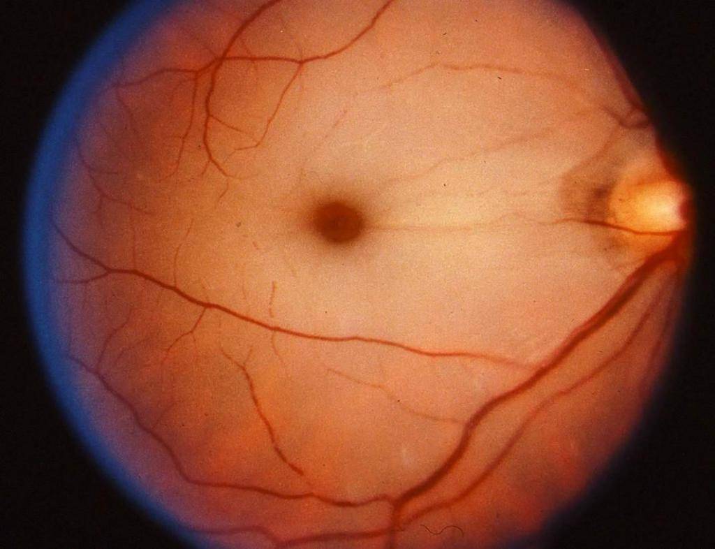 Макулярный отек глаза: виды (диабетический, диффузный, кистозный), причины и лечение
