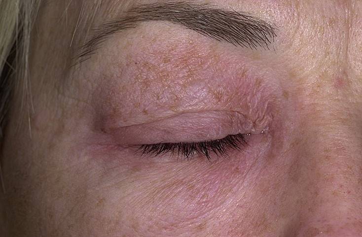 Шелушится кожа под глазами. причины и способы лечения сухости кожи век