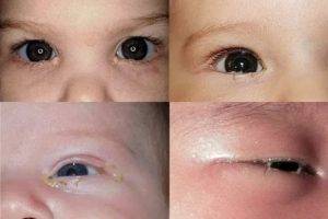 У ребенка гноятся глазки: пошаговая инструкция что делать и чем лечить болезнь глаз