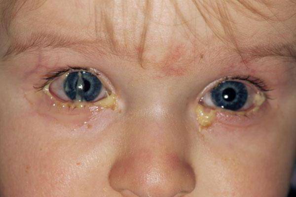 У ребенка гноятся глаза: что делать, если гной, чем лечить, если загноился глазик