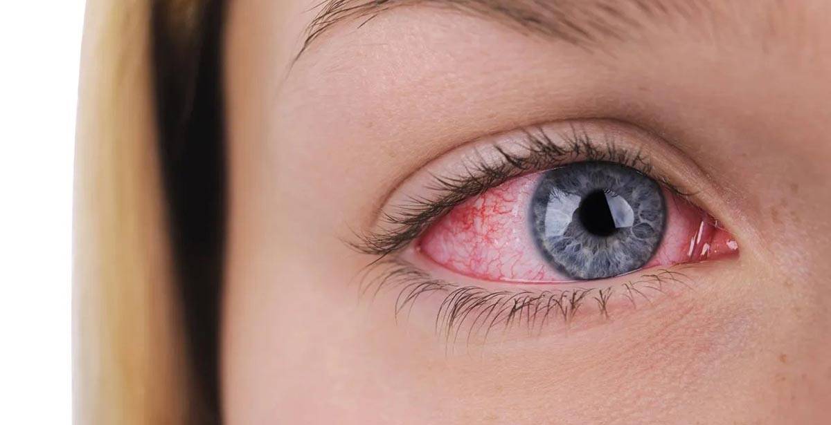 Один глаз красный другой нормальный: причины воспаления