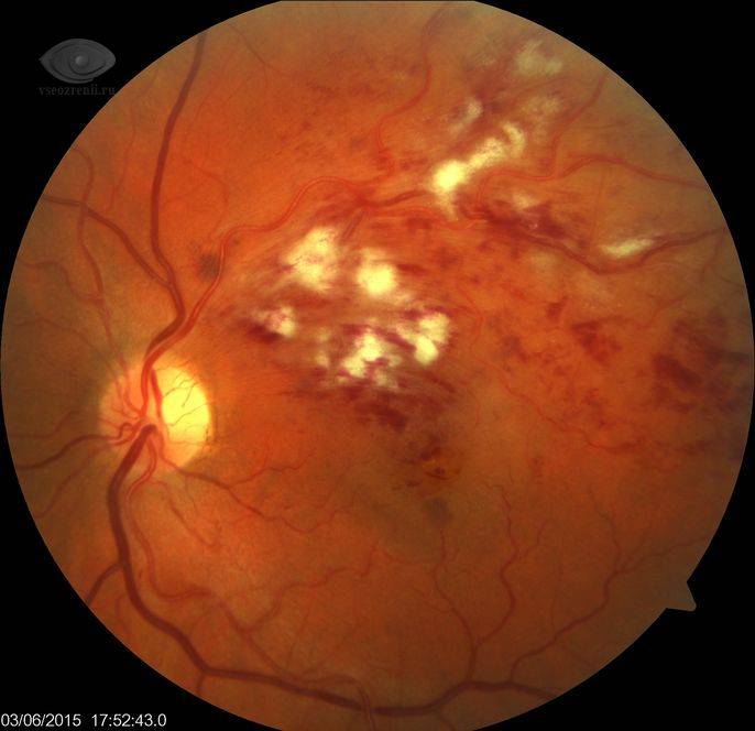 Тромбоз центральной вены сетчатки глаза: причины, симптомы по стадиям окклюзии, методы лечения