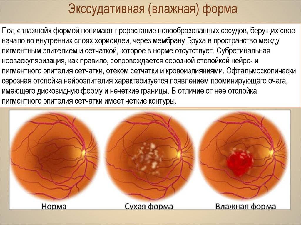 Макулодистрофия сетчатки глаза (макулярная дегенерация)