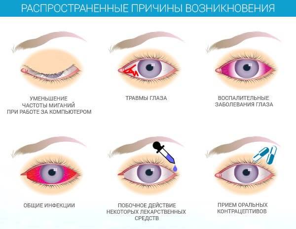 Сухой глаз. симптомы синдрома сухого глаза. причины сухости в глазах, диагностика и лечение патологии. какие капли капать при сухом глазе?