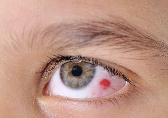 Что делать, если лопнул капилляр в глазу?