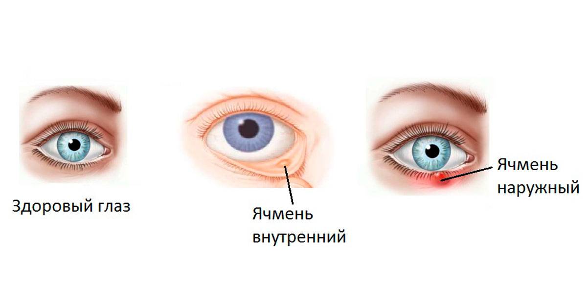 Внутренний ячмень на глазу: лечение, причины, симптомы (фото), как выглядит мейбомит, осложнения