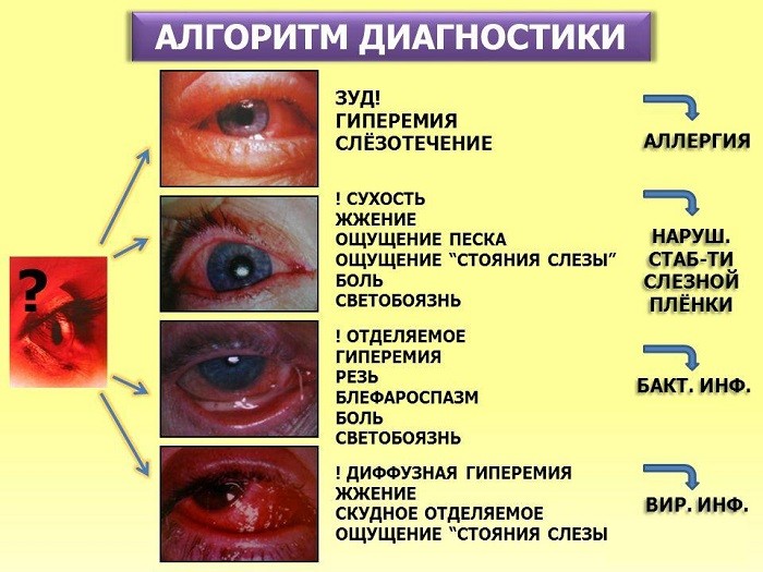 Причины конъюнктивита глаз у взрослых: лечение, факторы риска, провоцирующие заболевания